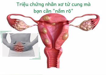Triệu chứng nhân xơ tử cung mà bạn cần nắm rõ - Xem ngay!